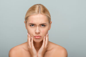 Acne Treatment